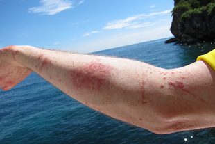 how to treat jellfish stings