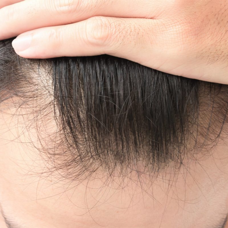 Hair loss treatment