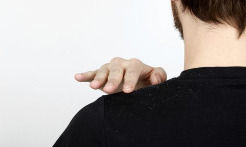 Man with dandruff