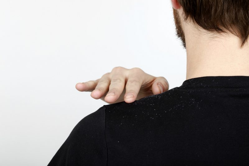 Man with dandruff