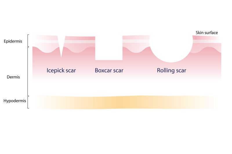 Acne Scars