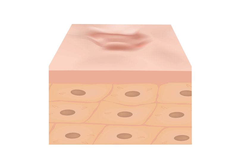 Hypertrophic Scars