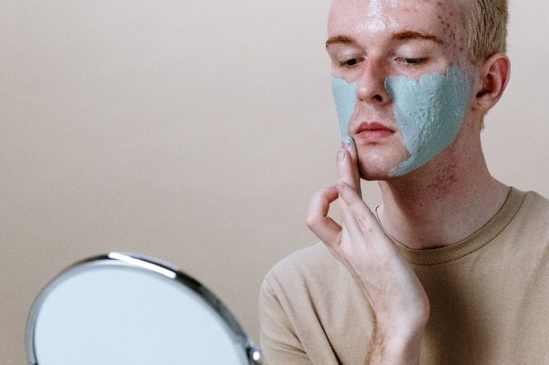 Acne scars