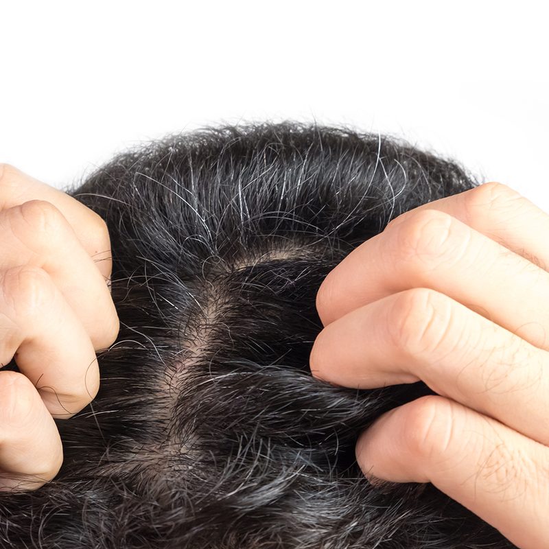 Man showing his scalp