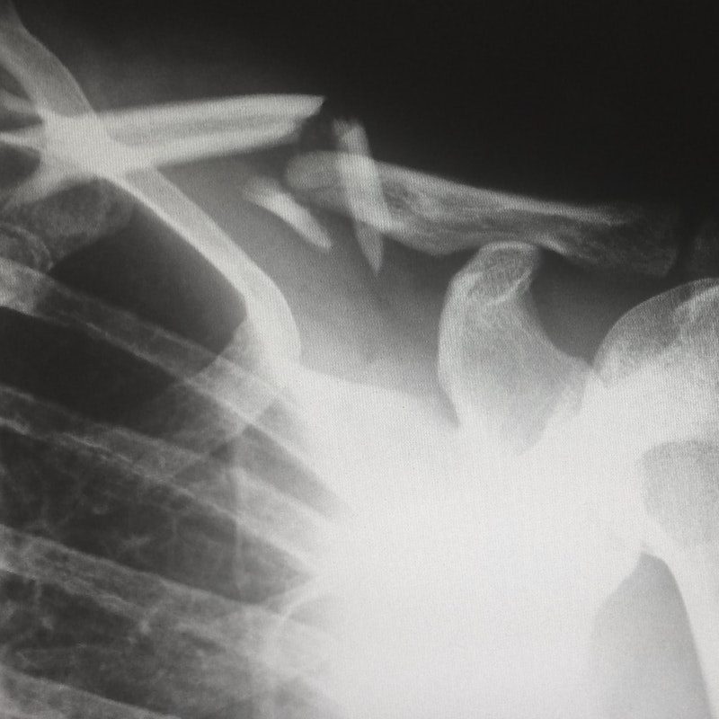 X-ray showing broken clavicle