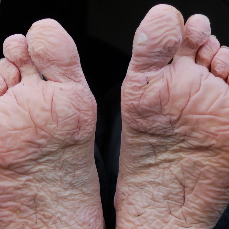 A mild case of trench foot