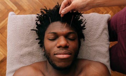 a man receiving acupuncture on his face
