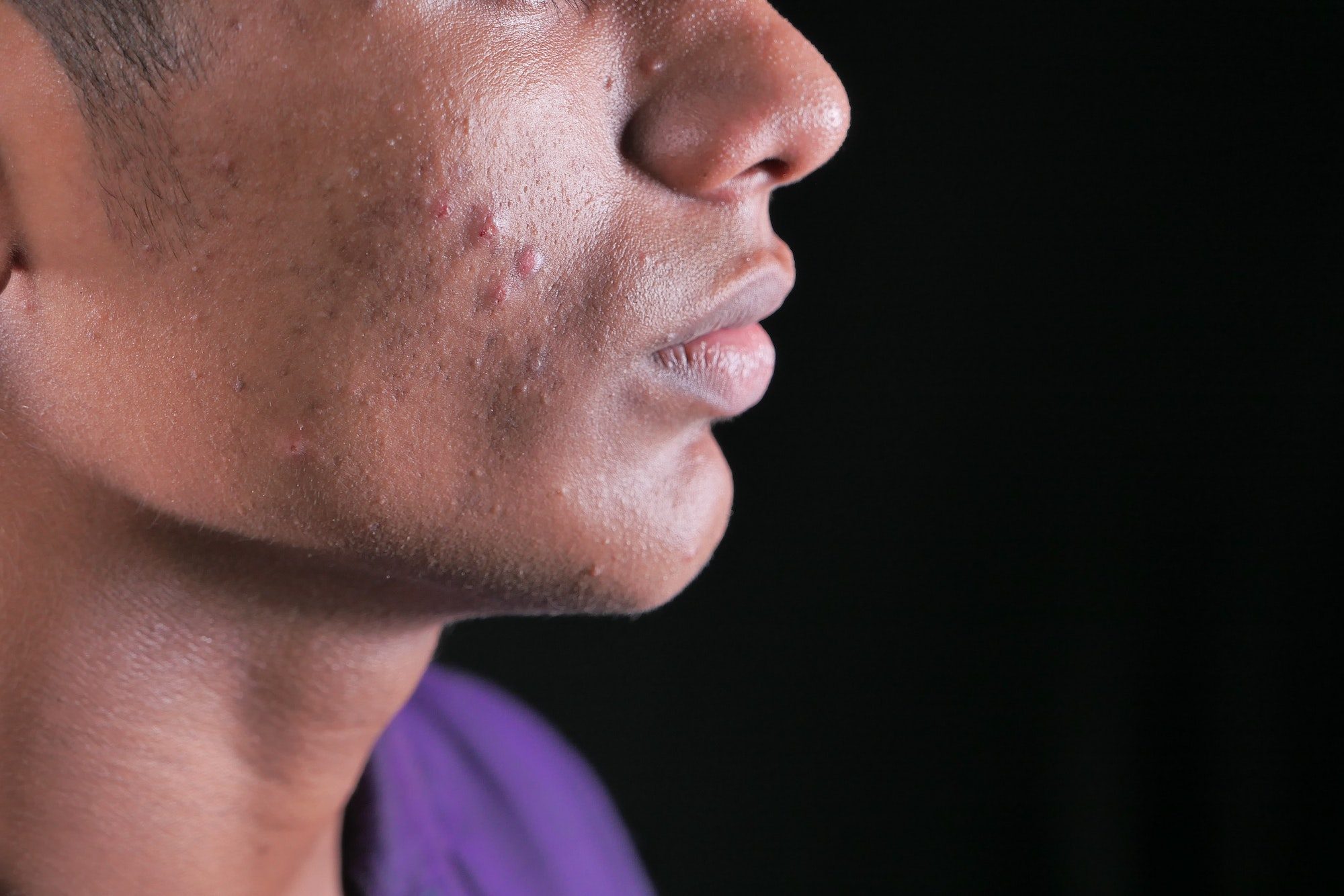 How to get rid of whiteheads