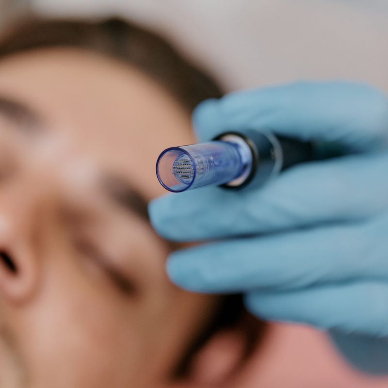Man getting his face micro-needled.