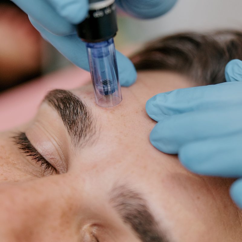 Micro-needling on a man's face.