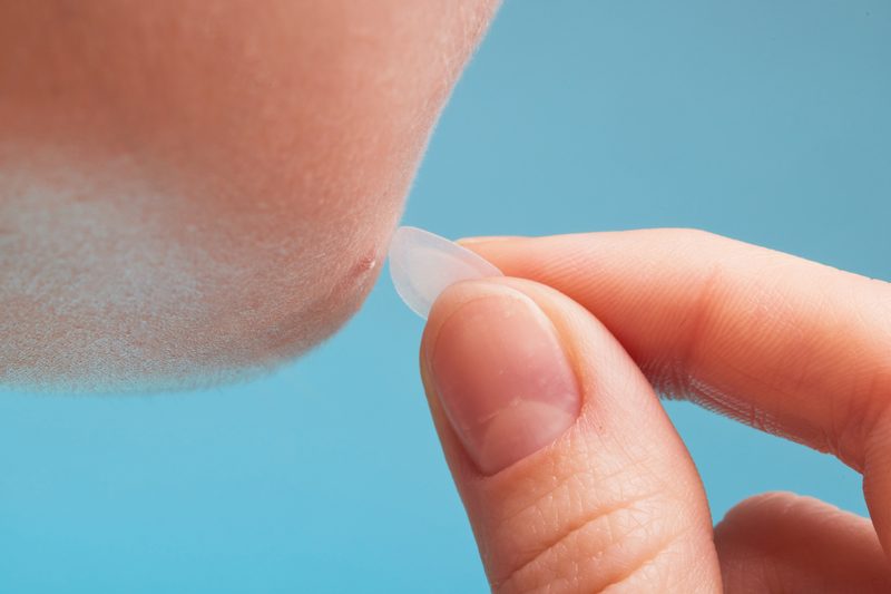 Using acne patches for treatment of pimple and rosacea close-up.