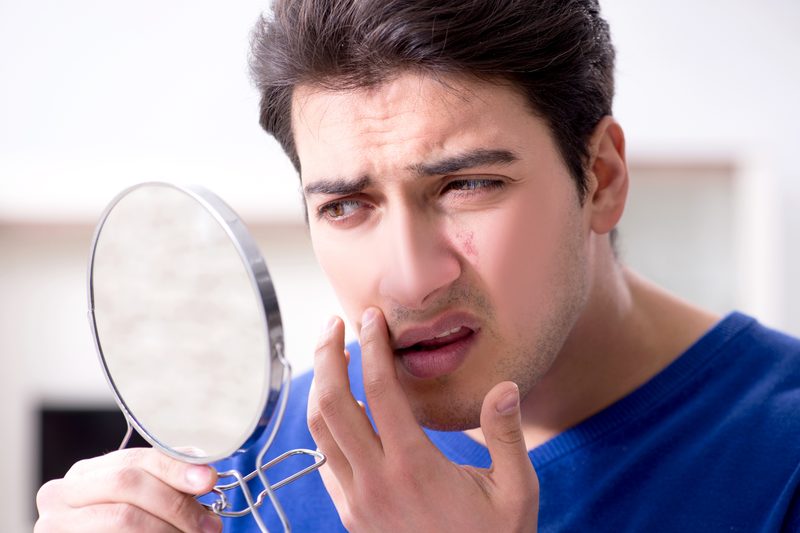 Acne scars
