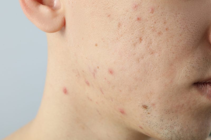 Acne scars