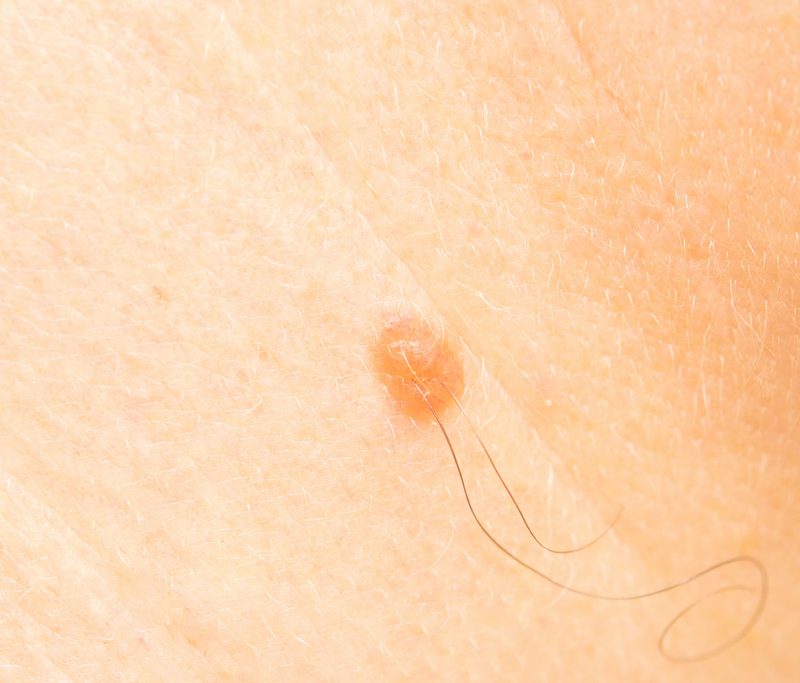 How to prevent ingrown hairs