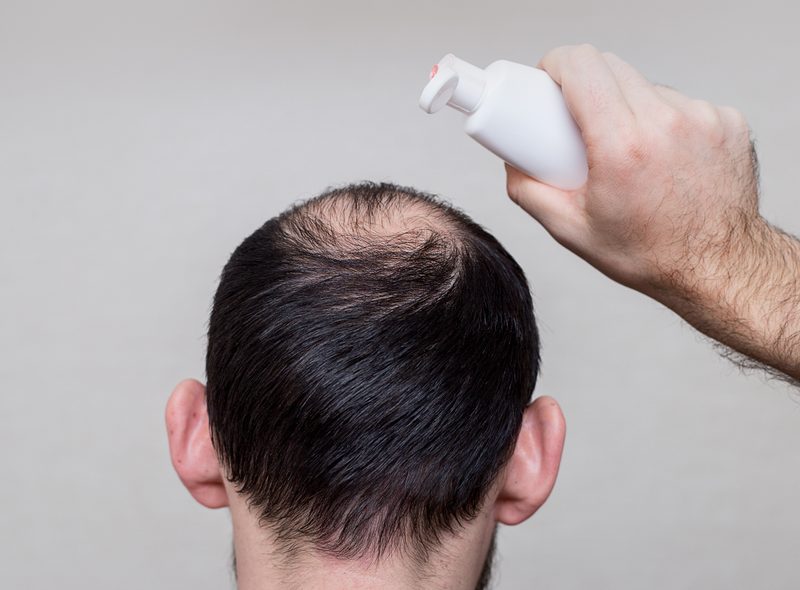 Hair loss products