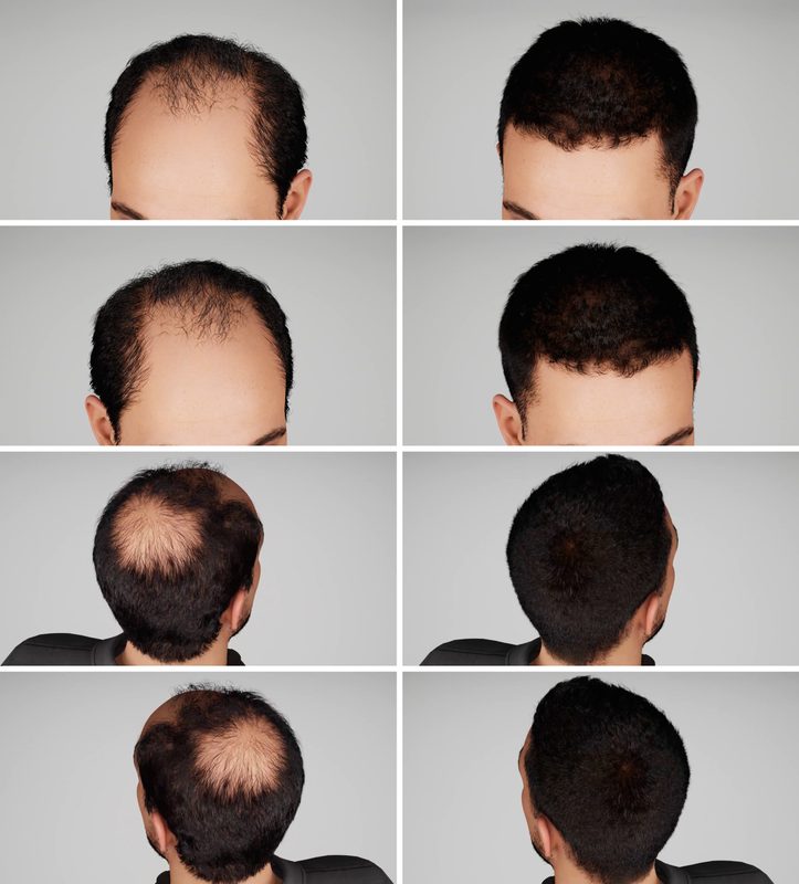 Hair loss products