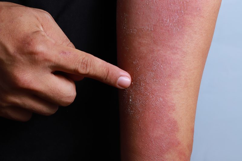 Reduce skin redness