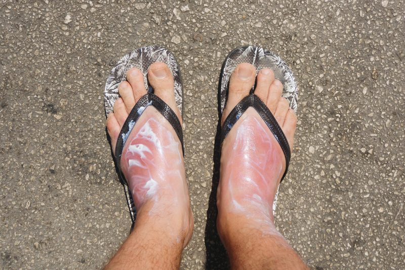 How to treat sunburn