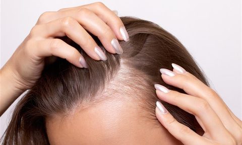 GLP-1 hair loss