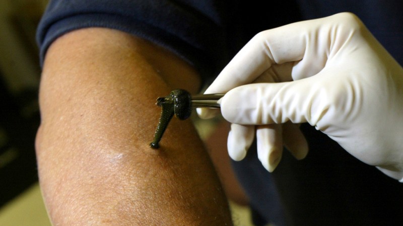 leech removal