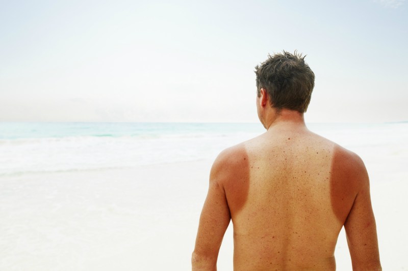 Man with a sunburn on his arms