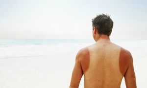 Man with a sunburn on his arms