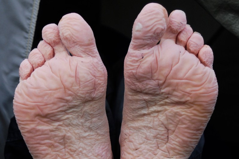 A mild case of trench foot.
