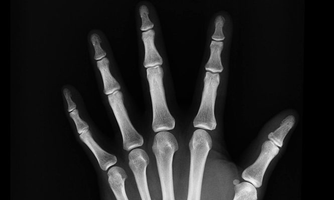 X ray hand skeleton